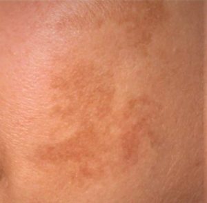 Scopri di più sull'articolo Le macchie cutanee in gravidanza